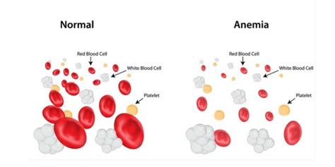 Iron Deficiency Anemia Why It Happens And What To Do About It