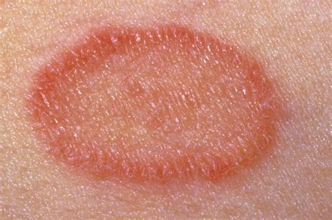 Pityriasis Rosea Nhs 金宝搏app