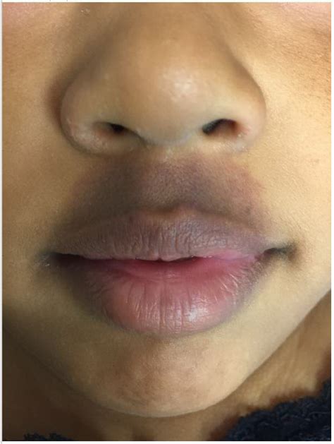 What Caused This Year Old Girls Facial Bruise Consultant