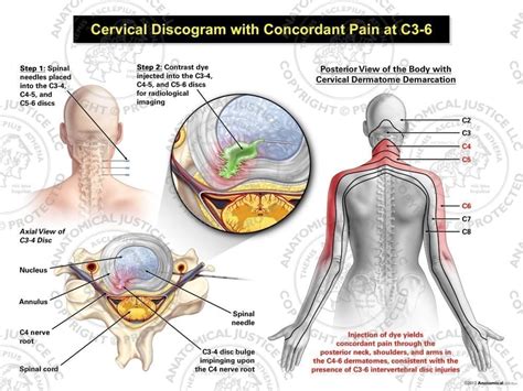 Female Right Cervical Discogram With Concordant Pain At C3 6