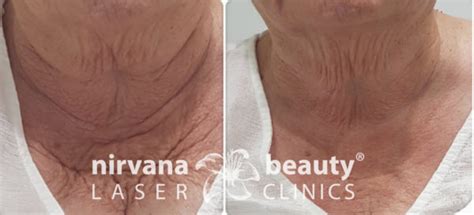 Hifu Before And Afters Nirvana Beauty Laser Clinics