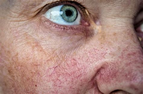 Why Do I Have Spider Veins On My Face And How Can I Get Rid Of Them