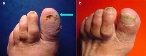 Successful Nonsurgical Therapy Of A Diabetic Foot Osteomyelitis In A