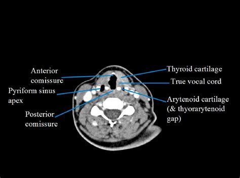 Hypopharynx And Larynx Anatomy Semantic Scholar