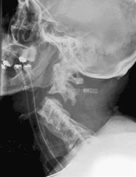 Plain Lateral X Rays Of The Cervical Spine Demonstrating A Complete