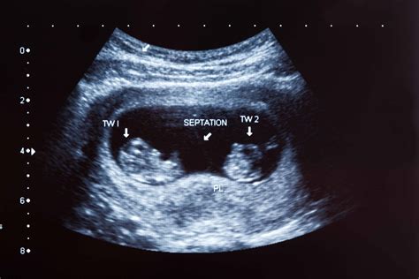 What Every Pregnant Woman Should Know About Screening Ultrasounds