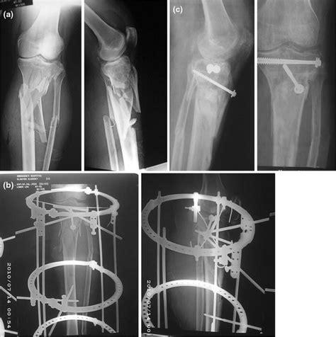 Outcomes Of Open Bicondylar Tibial Plateau Fractures Treated With
