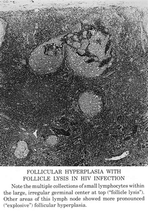 Pathology Outlines Follicular Hyperplasia