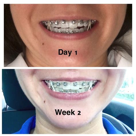 Achieve A Confident Smile With Adult Damon Braces