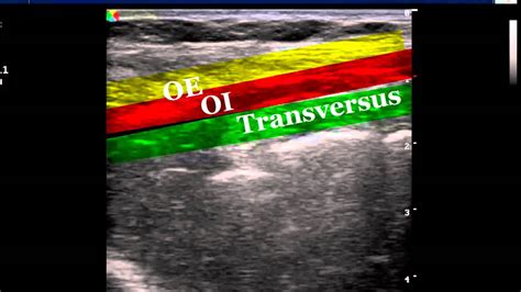 Ultrasound Guided Iliohypogastric And Ilioinguinal Nerve Blocks Youtube