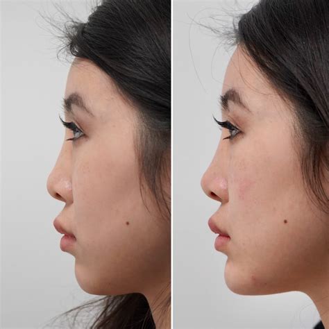 Dermal Fillers Concept Clinics Aesthetics And Cosmetic Medicine