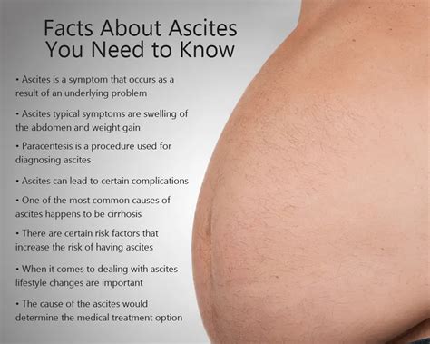 Ascites Excess Abdominal Fluid Causes Symptoms And Tr