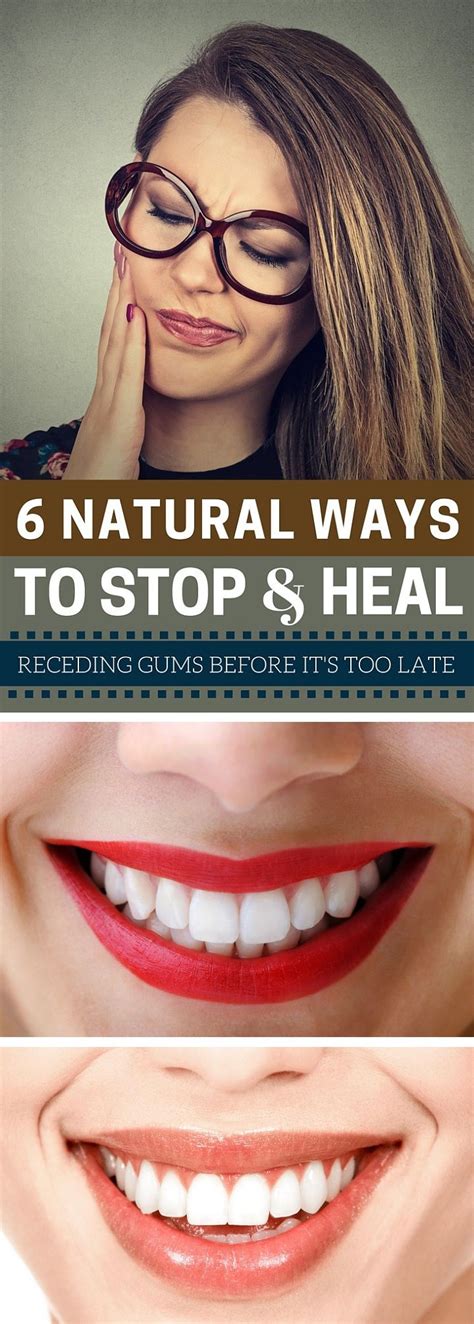6 Natural Ways To Stop And Heal Receding Gums Before Its Too Late