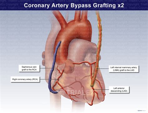 Coronary Artery Bypass Grafting X Trial Exhibits Inc