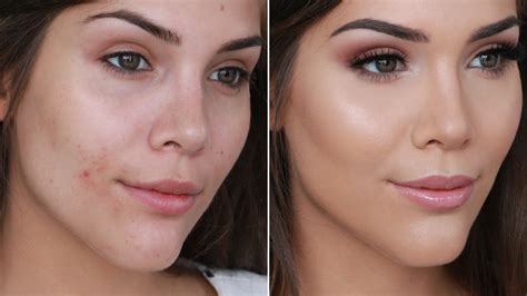 How To Cover Acne And Pimples With Makeup Katerina