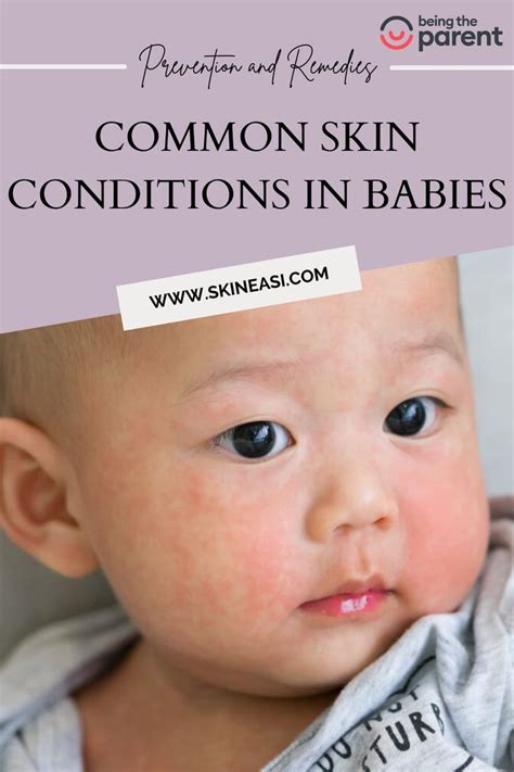 Common Skin Conditions In Babies Prevention And Remedies In 2022