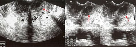 Cureus Evaluation Of Prostatic Lesions By Transrectal Ultrasound