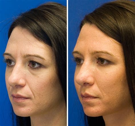 Using Radiesse Filler To Correct Prominent Smile Lines Seattle Facial