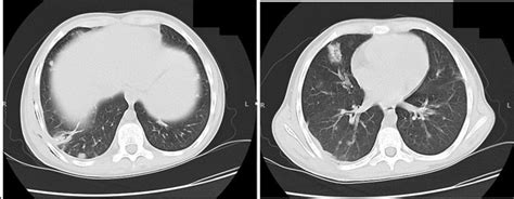 Ct Scan Of The Chest Showing Areas Of Patchy Consolidation And