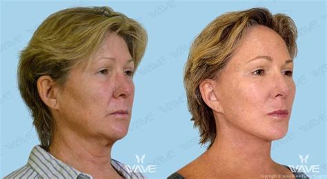 California Facelift Blog Wave Plastic Surgery