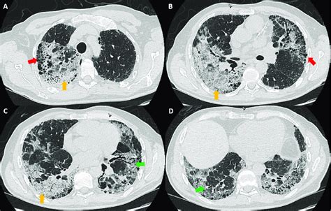 Computed Tomogram Of The Chest In Lung Windows Shows Honeycombing Red