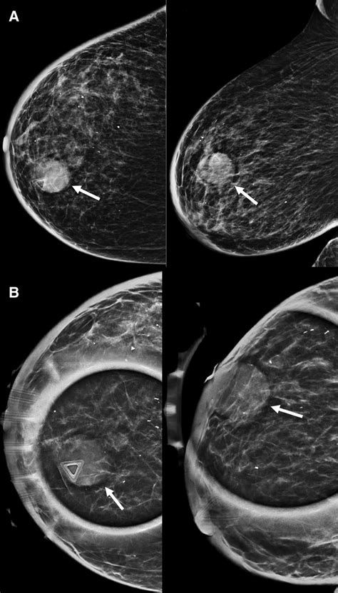 Mammogram Of The Right Breast A With Tomosynthesis Spot Compression