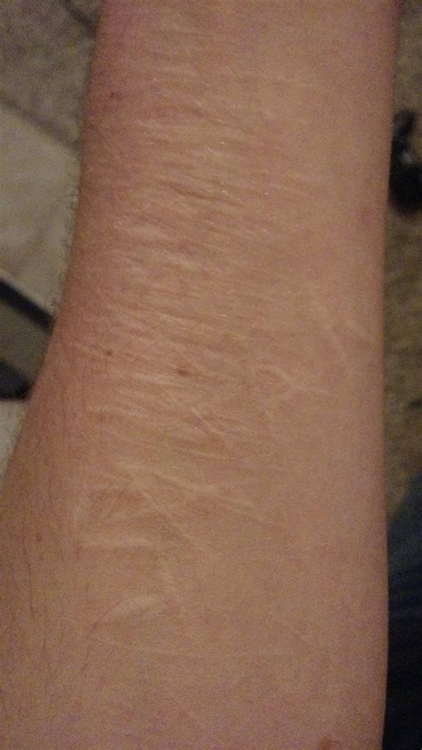 Basically, the body is a magnet. Trigger Warning (20m) deep and old self harm scars on ...