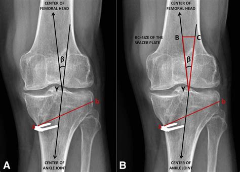 Opening Wedge High Tibial Osteotomy And Anterior Cruciate Ligament My