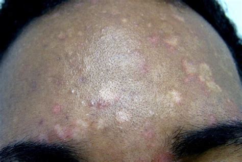 My current level for b12 is 157 pg. White spots on the skin: Possible causes and treatments ...