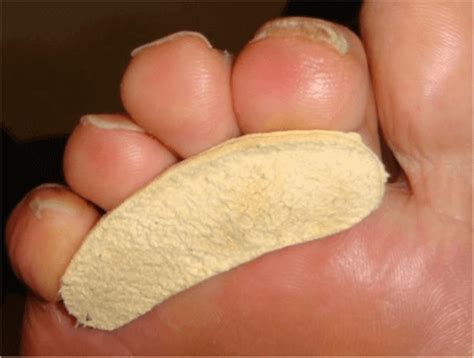 Blisters On Tips Of Toes Causes Prevention And Treatment