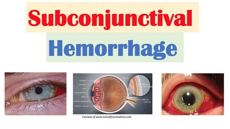 Subconjunctival Hemorrhage Blood In Eye Causes Signs And Symptoms
