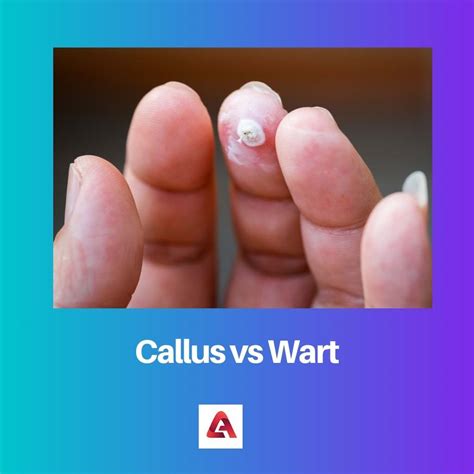 Difference Between Callus And Wart