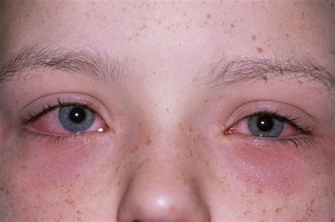 Dust Mite Allergy And Skin Rash Dust Allergy Rash 9 Tips For Eczema