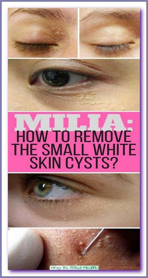 Milia How To Remove In 2023 Whiter Skin Skin Care Treatments Cysts