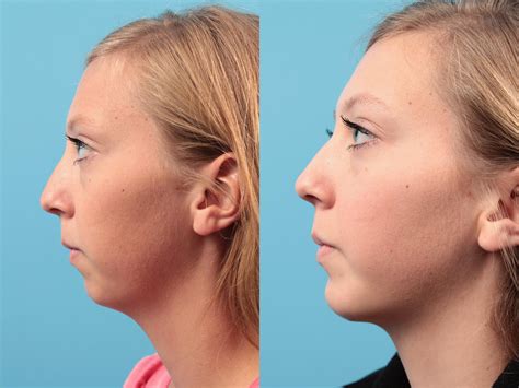 Chin Augmentation Before And After Pictures Case 27 West Des Moines