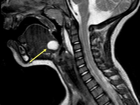 Thyroglossal Duct Cyst Tdc Diagnosis Mri Online