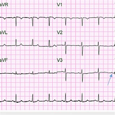 Ekg On The 19th Day Of Hospitalization Showing Atrial Flutter With