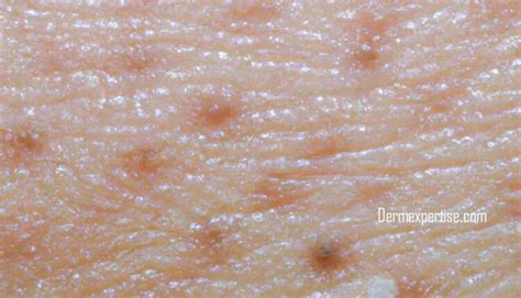 Actinic Keratosis Treatment Options Tell Us What Is Actinic Keratosis