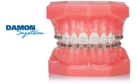 Damon System The Ivory Dental Clinic