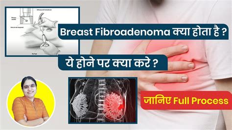 Breast Fibroadenoma In Hindi Causes Causes Symptoms Diagnosis