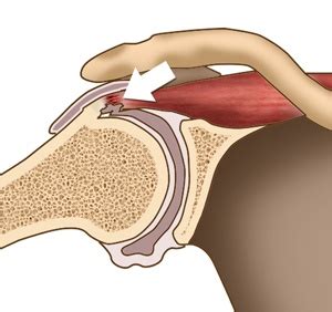 Internal Impingement Of The Shoulder Centreville VA Rotator Cuff
