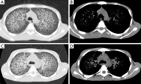 Paving Stone Ct Finding In A Pulmonary Tuberculosis Patient Huang
