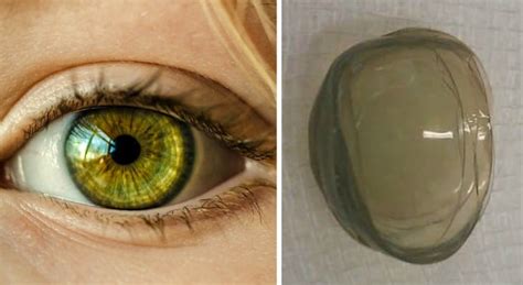 67 Year Old Woman Had 27 Contact Lenses On Her Eye And Just Found Out