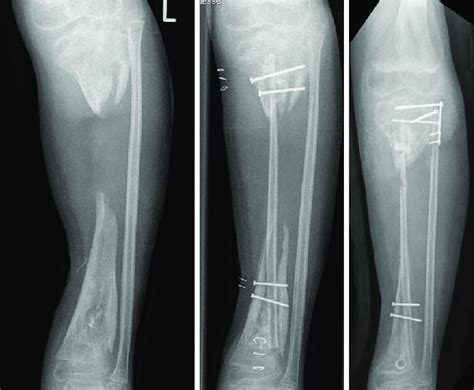 A 6 Year Old Boy With A Diaphyseal Tibial Defect After 14 Months