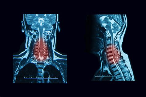 Cervical Spinal Stenosis The Orthopedic Pain Institute Beverly Hills