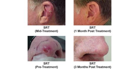 Superficial Radiation Therapy Srt Mid Atlantic Skin Surgery Institute
