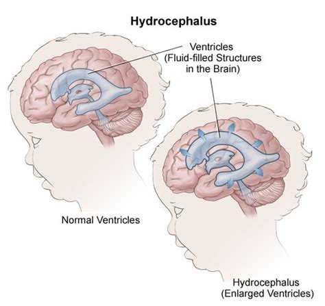 Hydrocephalus Nashville Neurosurgery Associates