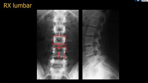 Radiografia De Columna Lumbar