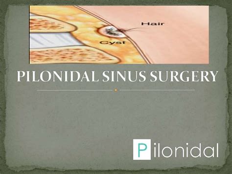 Pilonidal Sinus Surgery Available