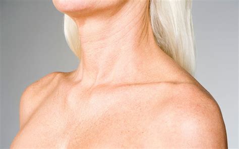 Neck And Décolleté Rejuvenation